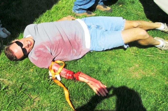 Traumatic arm amputation.