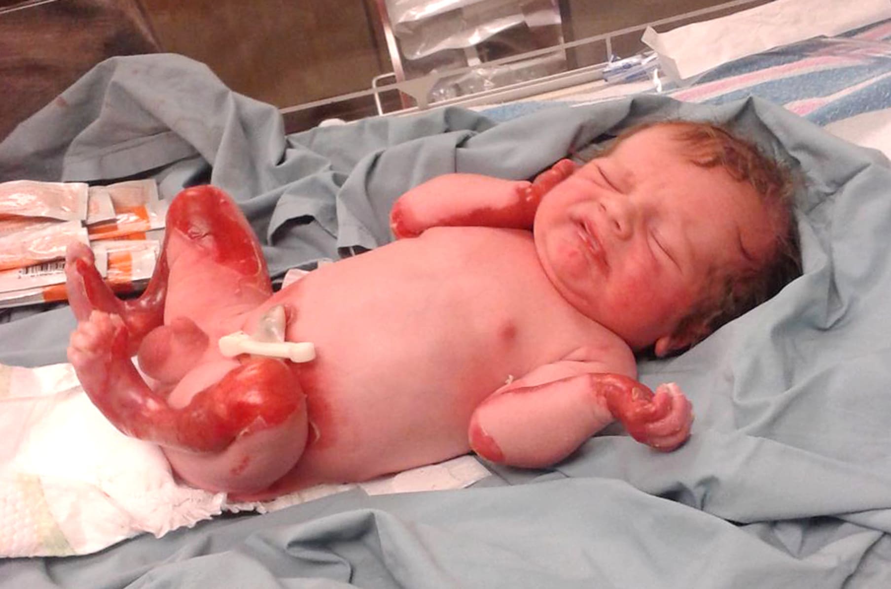 Epidermolysis bullosa top