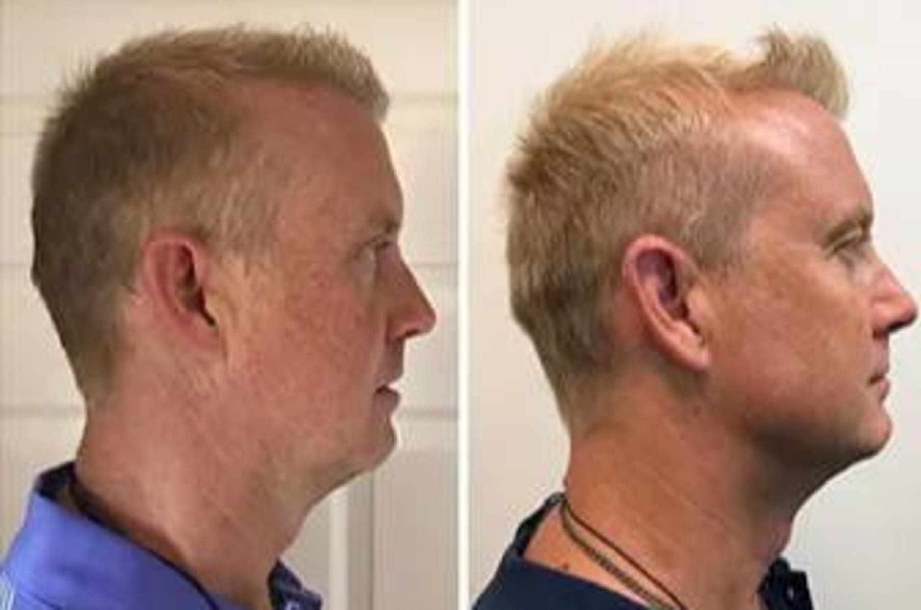 Workout jaw clearance